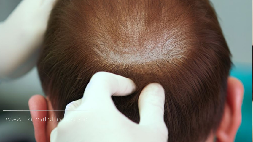 التشاور مع طبيب زراعة الشعر